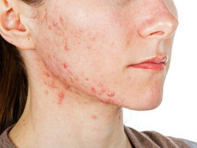 remedios caseros para el acné en adultos